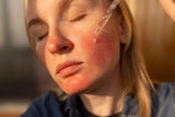 Peeling bei Rosacea: Eine Gratwanderung