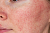 What is Rosacea or Couperose: Treatment and Experiences