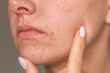 Periorale Dermatitis: Ursachen, Symptome und Behandlung