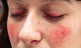 What is rosacea or couperose: treatment and experiences