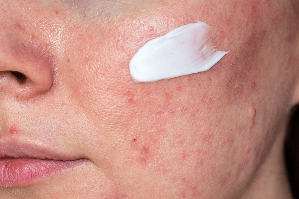 Rosacea-Pflege: Schluss mit Rötungen - endlich entzündungsfreie Haut