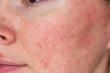 Was ist Rosacea oder Couperose: Behandlung und Erfahrungen